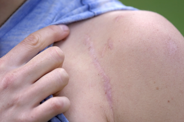 Rachel Atherton Nerve Graft scar
