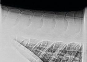 Kissing spines shown on x-ray