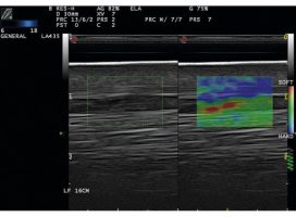 Elastography