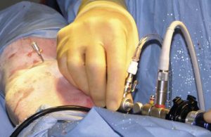Arthoscopy