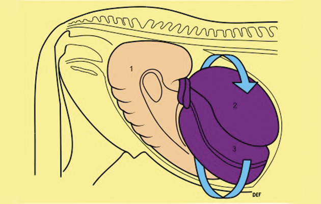 2-diagram-colon-torsion-shows-how-the-colon-can-twist