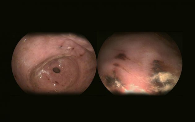 Bleed-in-Ulcers-3-and-4