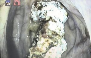 5 - Fungal plaques viewed through an endoscope.