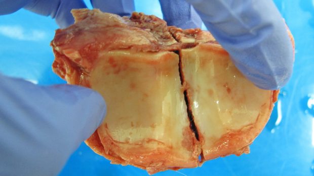 Bone fracturers in horses: