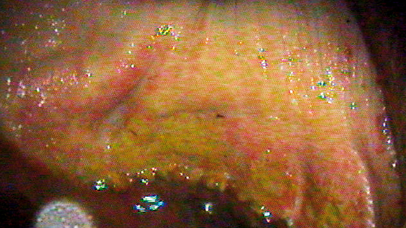 SEIB_Gastric-Ulcer_1400x788