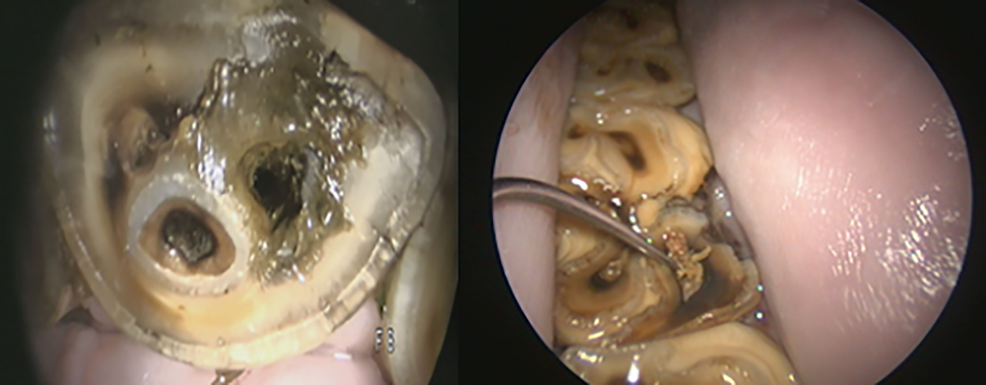 Close up of treatment for an equine tooth infection