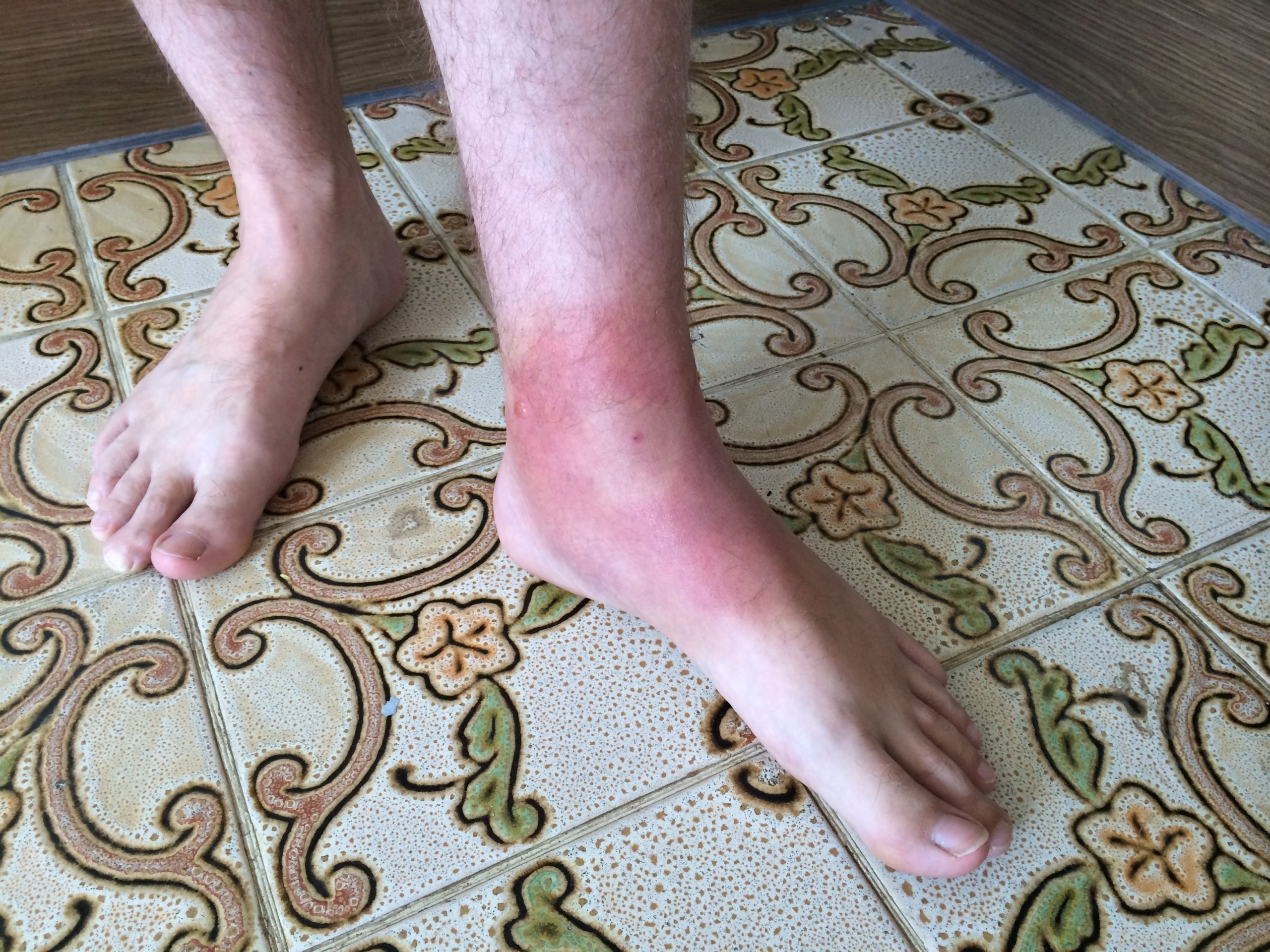large ankle rash