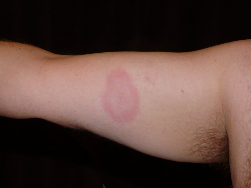 arm rash