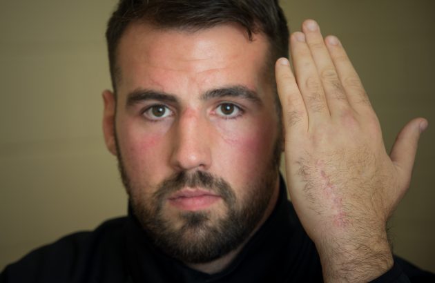 Scott Baldwin shows the scar from the lion bite