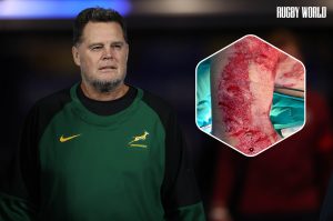 Rassie Erasmus burns